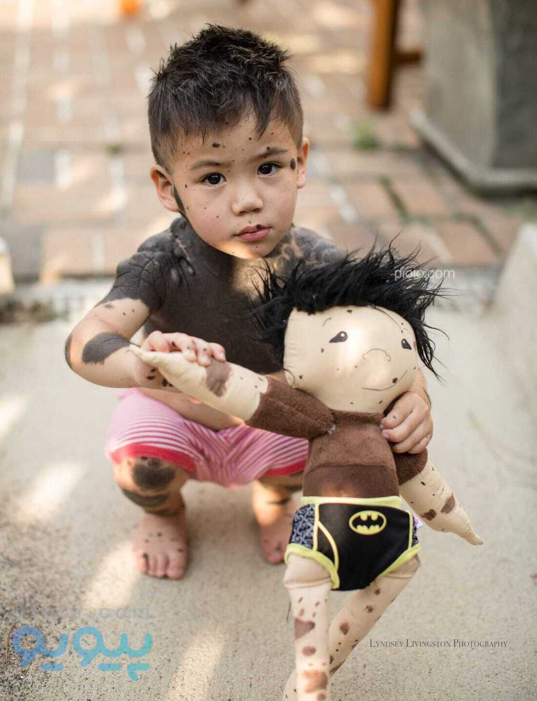 عروسک با بیماری خال ملانوسیتی